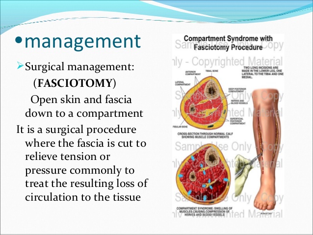 5-2-compartment-syndrome-copy
